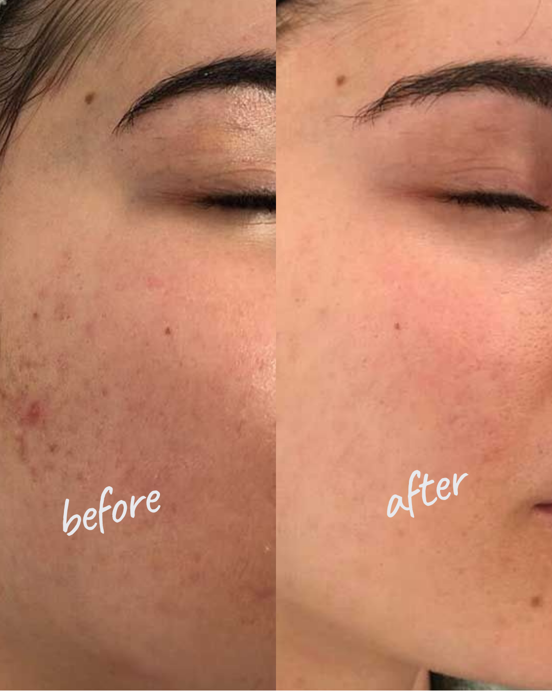 Biorevitalization Result — Hydrated Glowing Skin NYC